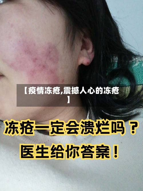 【疫情冻疮,震撼人心的冻疮】